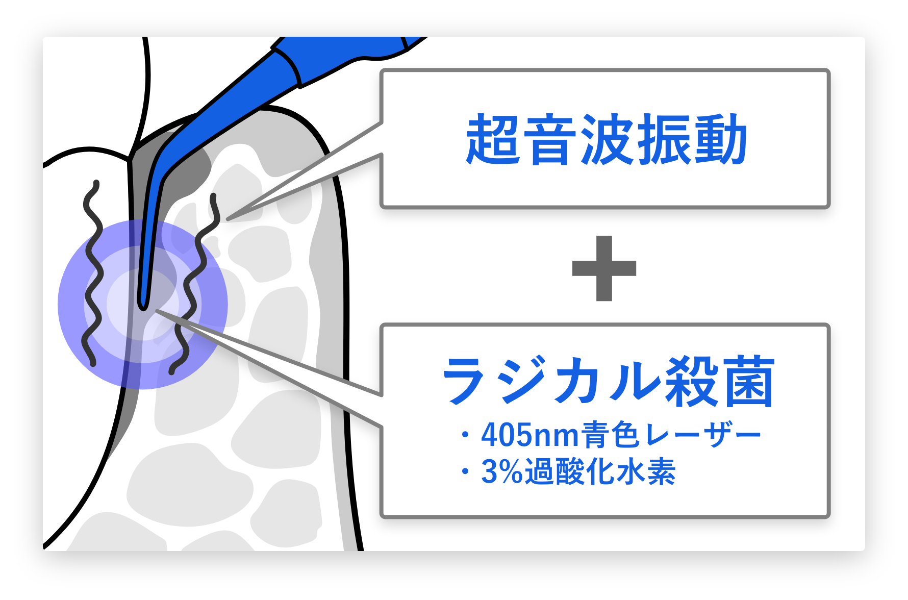 ブルーラジカル治療の図解
